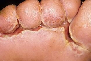 Sintomi del fungo dell'unghia del piede