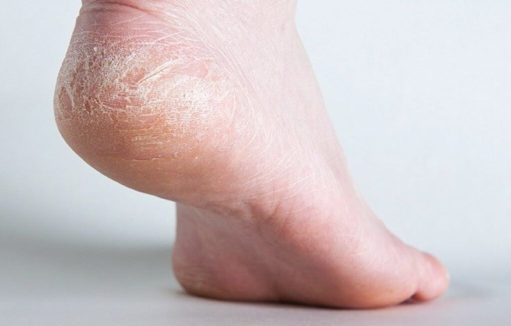 come trattare il fungo della pelle sulla gamba