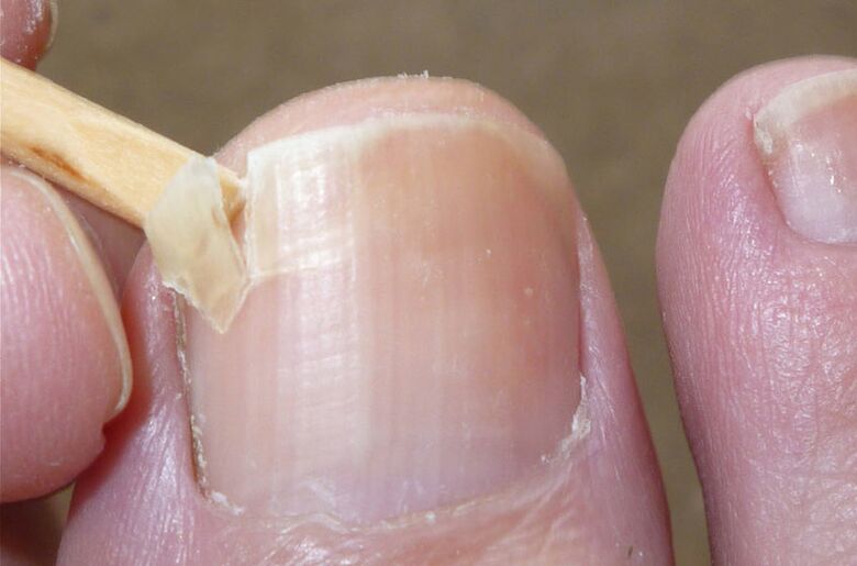 Le unghie danneggiate sono un fattore di rischio per un’infezione fungina