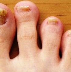 Piede di nogs