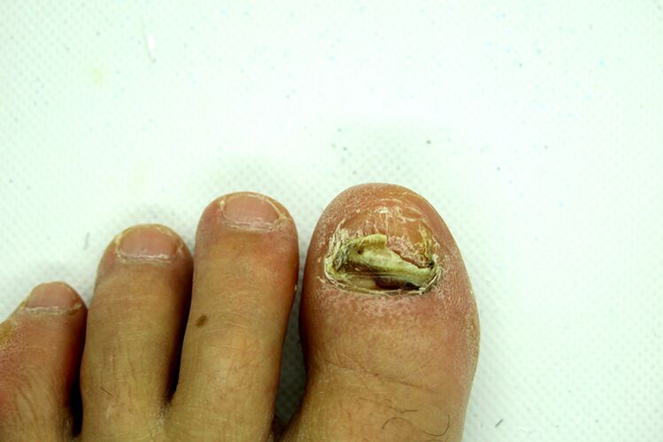 Fingernail Fungo - Stage pesante