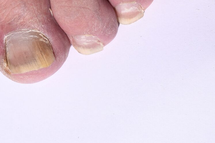 La fase iniziale della micosi delle unghie sulle gambe
