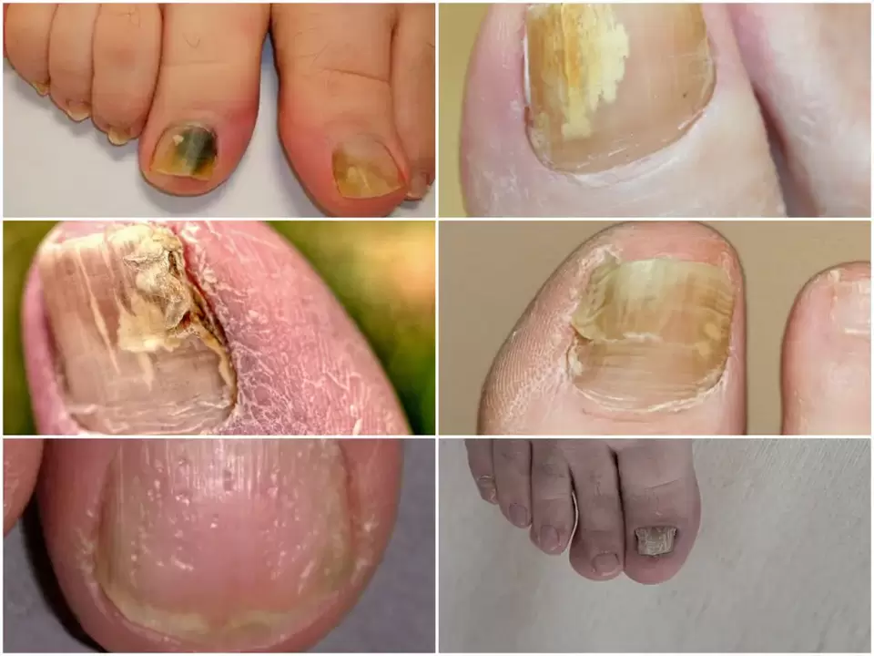 Sintomi di onicomicosi – cambiamenti nel colore e nella struttura delle unghie