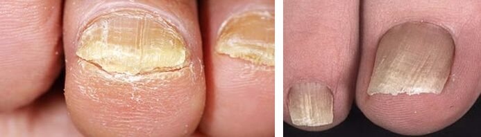 Danni alle unghie da un'infezione fungina