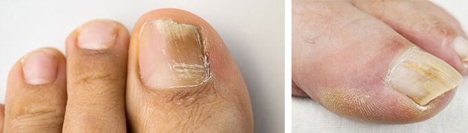 Foto di un'infezione fungina sull'unghia del piede