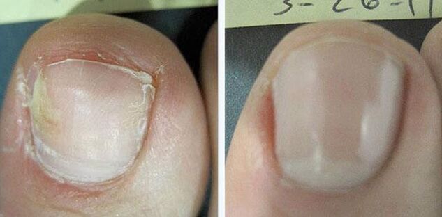 prima e dopo il trattamento per il fungo delle unghie