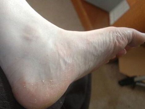 Peeling del piede della gamba come segno di un'infezione fungina